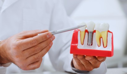 Dental Implants Tirupati